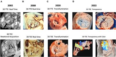 3D echocardiography in mitral valve prolapse